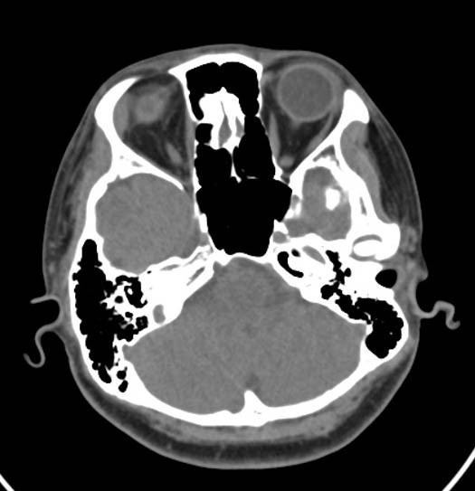 Unremarkable Ct Scan Of The Chest معنى Captions Beautiful