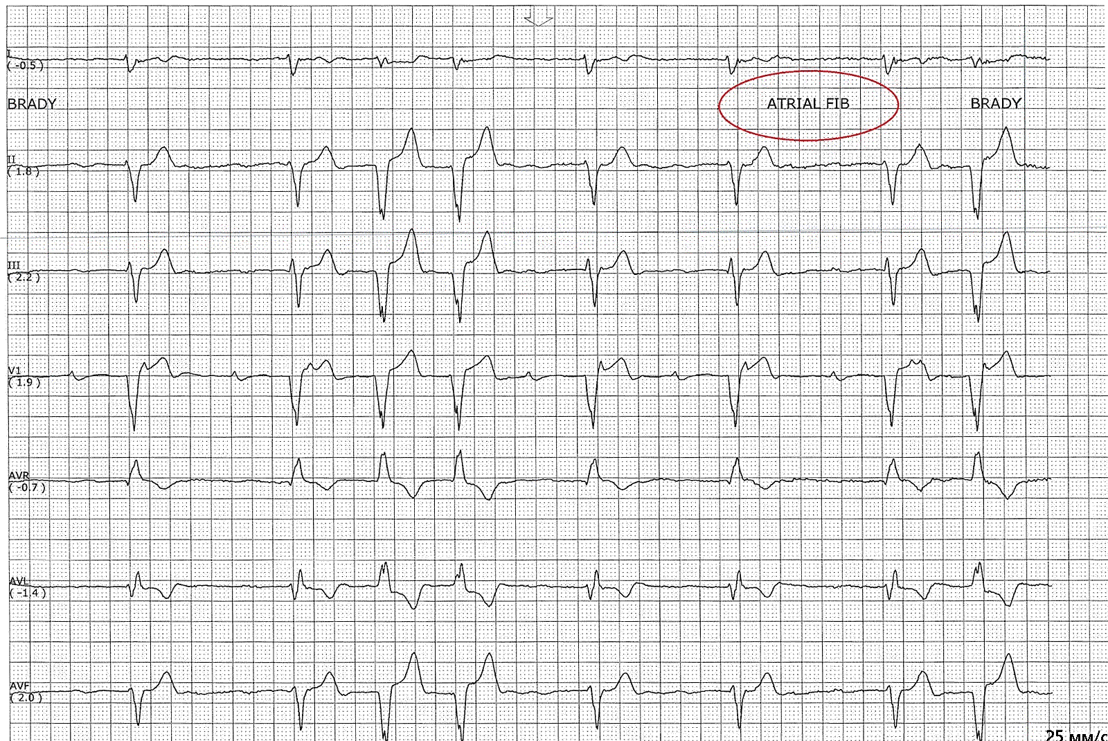 брадисистолическая форма фибрилляции предсердий