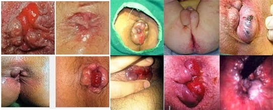 Jual Obat Ambeien Bisa Di Antar Ke Halmahera Barat