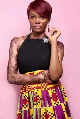ra "I don't focus on how big my giant is; I focus on how Gigantic my God is" Nigerian burn survivor shares lovely photos