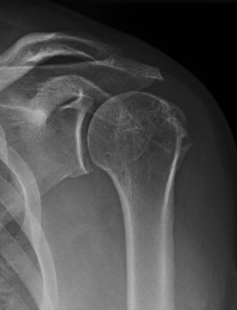 UW Shoulder and Elbow Academy Irreparable rotator cuff tear after