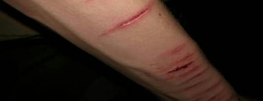 الكاتينج بداية الطريق للانتحار