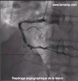 Angioplastie Coronaire Resultat