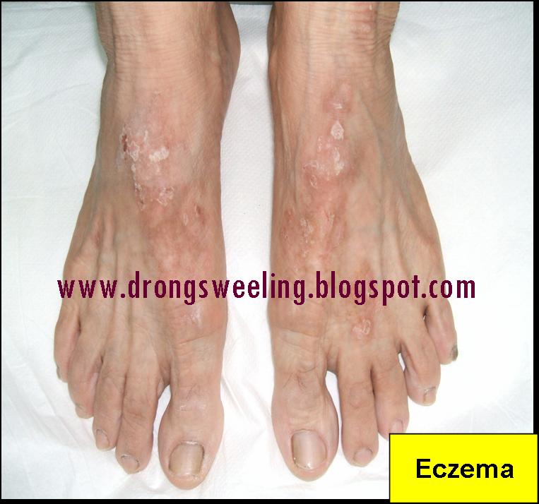 TCM News Best TCM Dermatologist Singapore for Eczema & Psoriasis