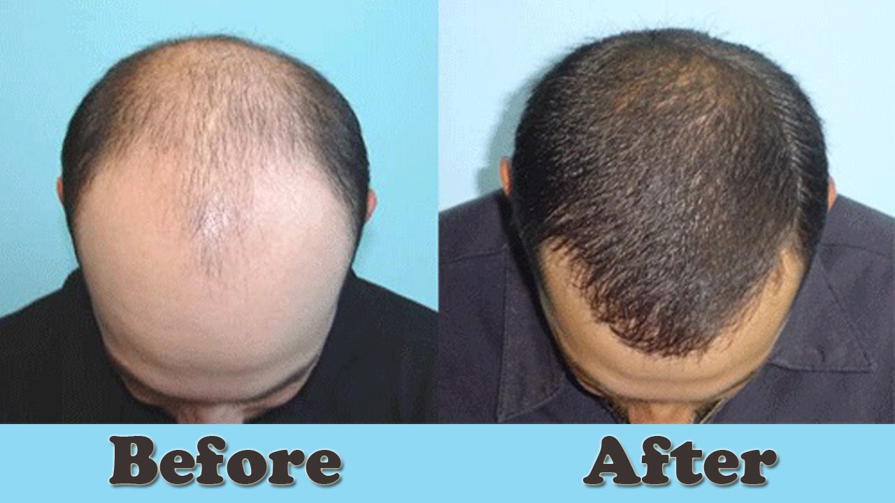 How To Regrow Hair On Blad Spot