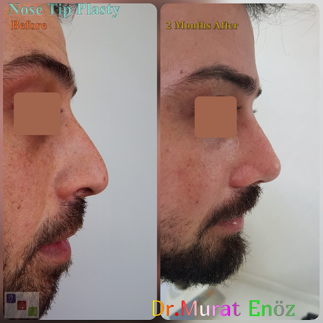 Male Nose Tip Plasty Surgery in Turkey,Nose Tip Reshaping For Men,Nose Tip Surgery For Men,Male Nose Tip Plasty Operation in Istanbul,Men's Nose Tip Plasty,