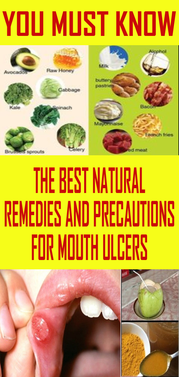 The Best Natural Remedies And Precautions For Mouth Ulcers Exstremboard
