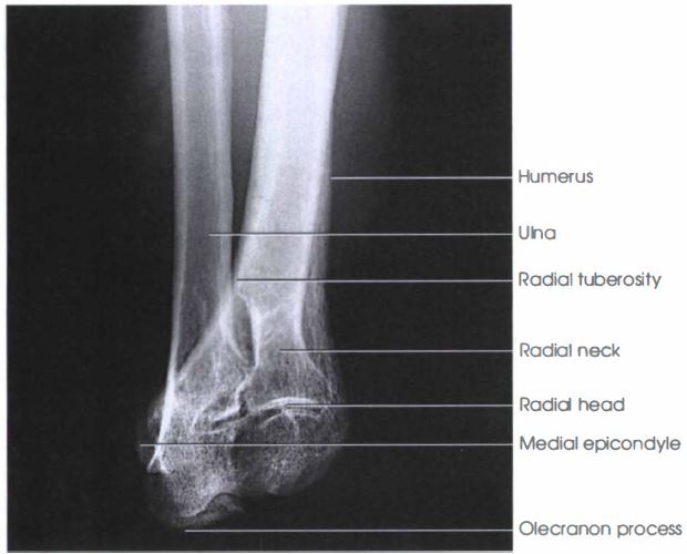 Proximal Forearm Pa Projection Acute Flexion Radtechonduty
