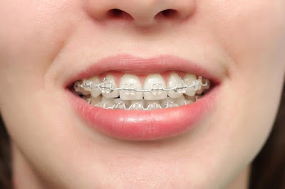 Niềng răng hô có lợi ích gì?
