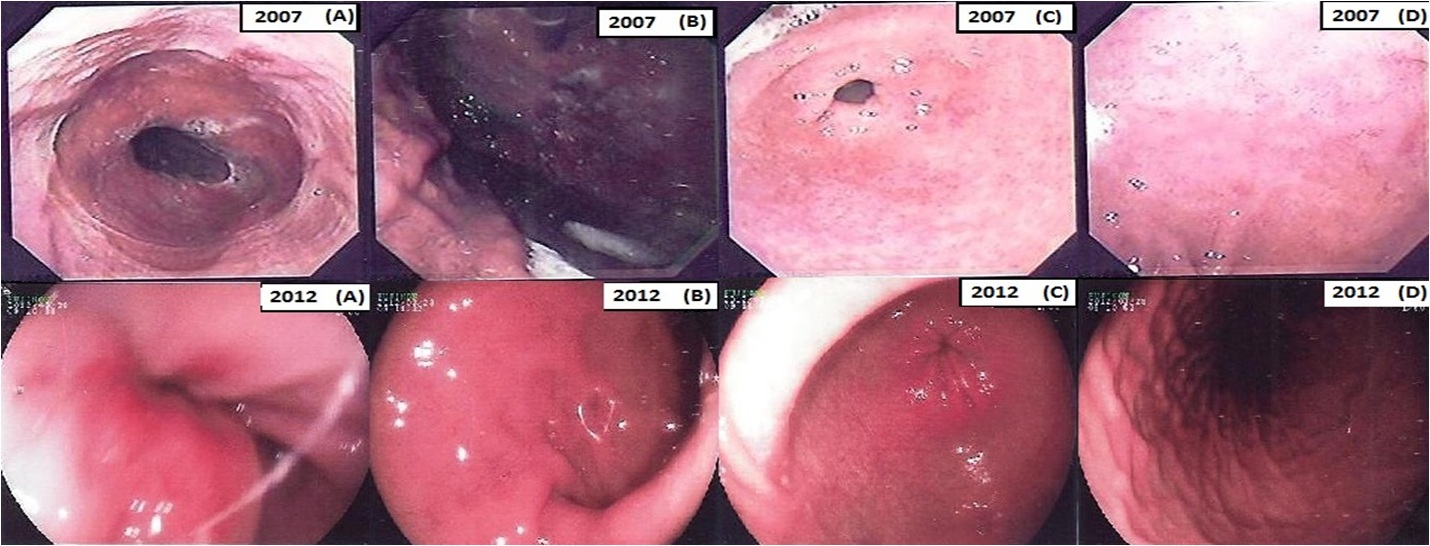 dieta h pylori gastrite)