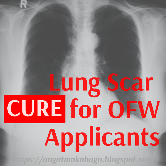 Lung Scar Cure for OFW Applicants
