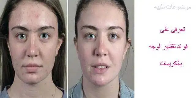 طريقة الانتصاب التاريخية للصداع بتقشير الوجه بالكريمات المنزلية Dsvdedommel Com