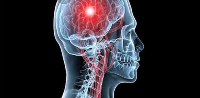 علامات الموت الدماغي علامات الموت الدماغي