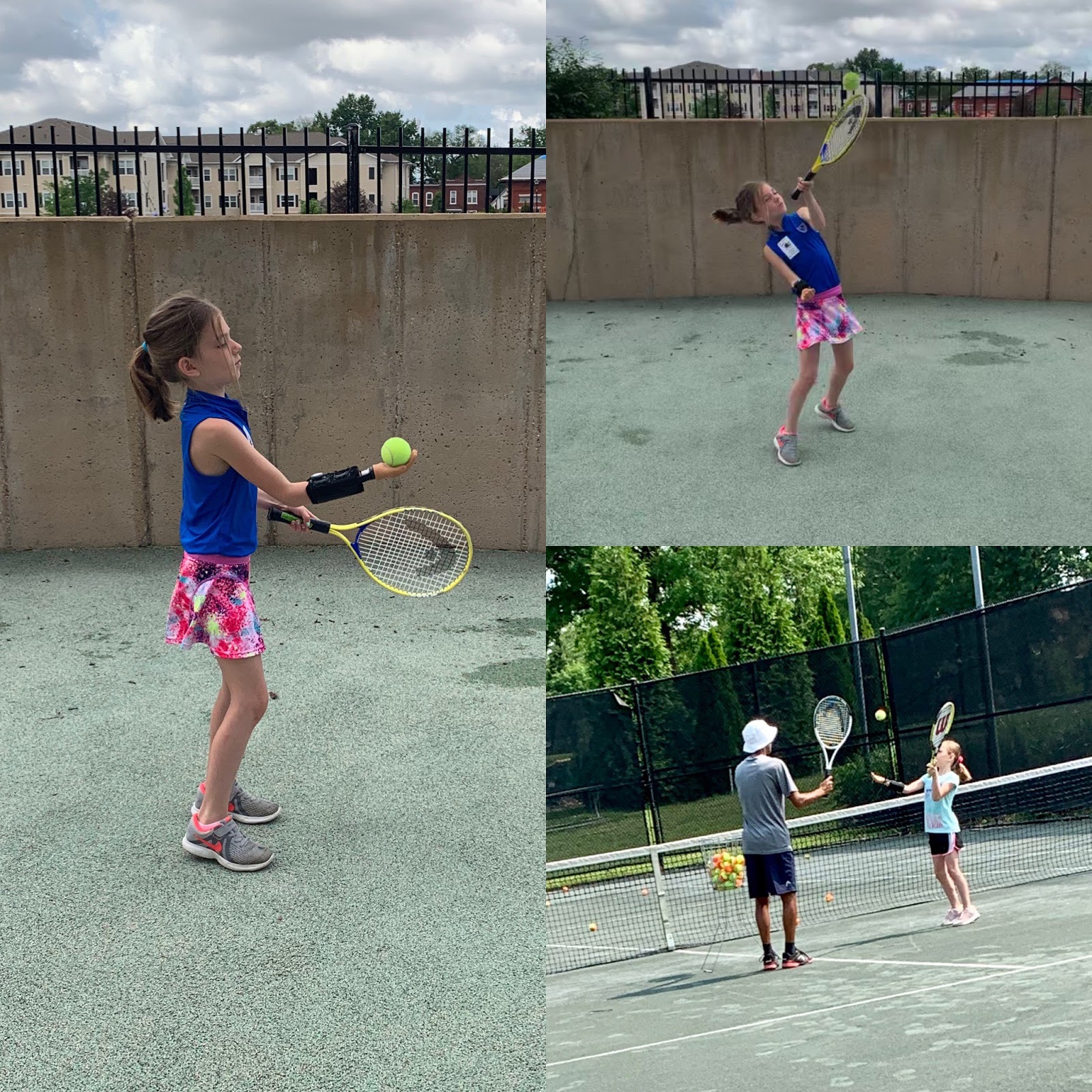 Types of prosthetics picture