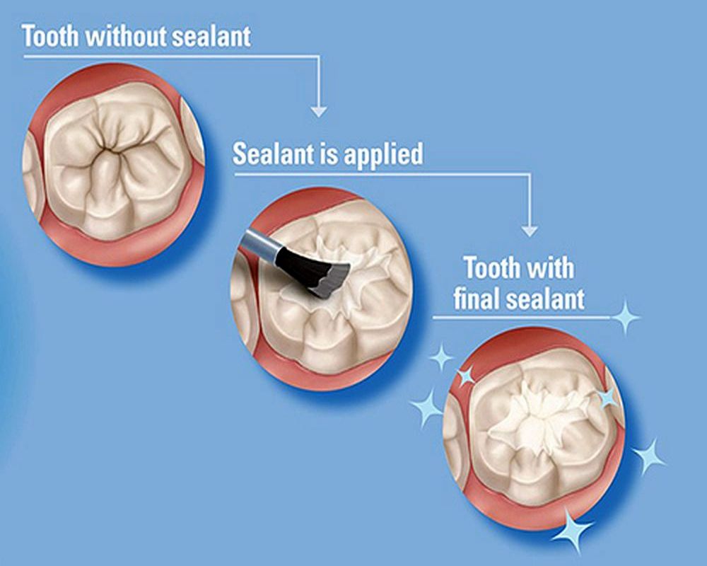 How to Apply Clinpro Sealant Step by step OdontoVida