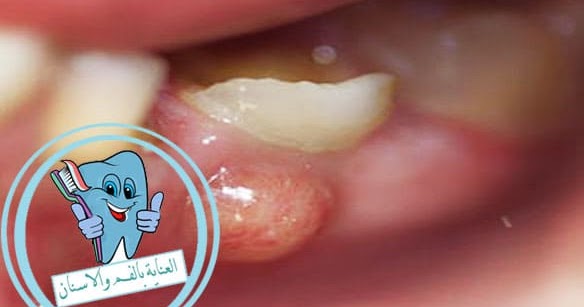 رائد بيلي المستوطنون كيف يتم تنظيف خراج الاسنان Udruzenje Pisaca Cegar Nis Com