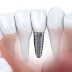 Trồng răng implant có đau không, có hiệu quả không?