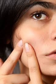 9 घरेलू आयुर्वेद से करें पिम्पल और एक्ने का इलाज- Ayurvedic treatment for acne and pimple in hindi, मुंहासे निकलने का कारण- causes of pimple in hindi, ये प्रमुख पिम्पल होते है- types of pimple in hindi