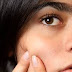 9 घरेलू आयुर्वेद से करें पिम्पल और एक्ने का इलाज- Ayurvedic treatment for acne and pimple in hindi