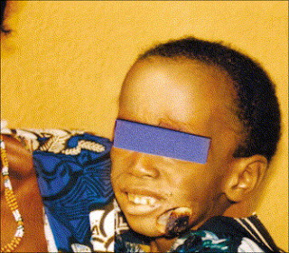 face eating disease nigeria face eating disease nigeria