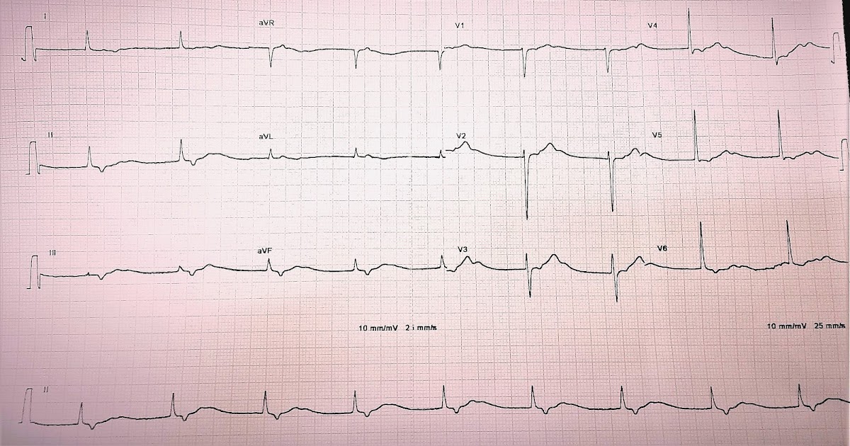 ECG Challenge 3 Inverted waves