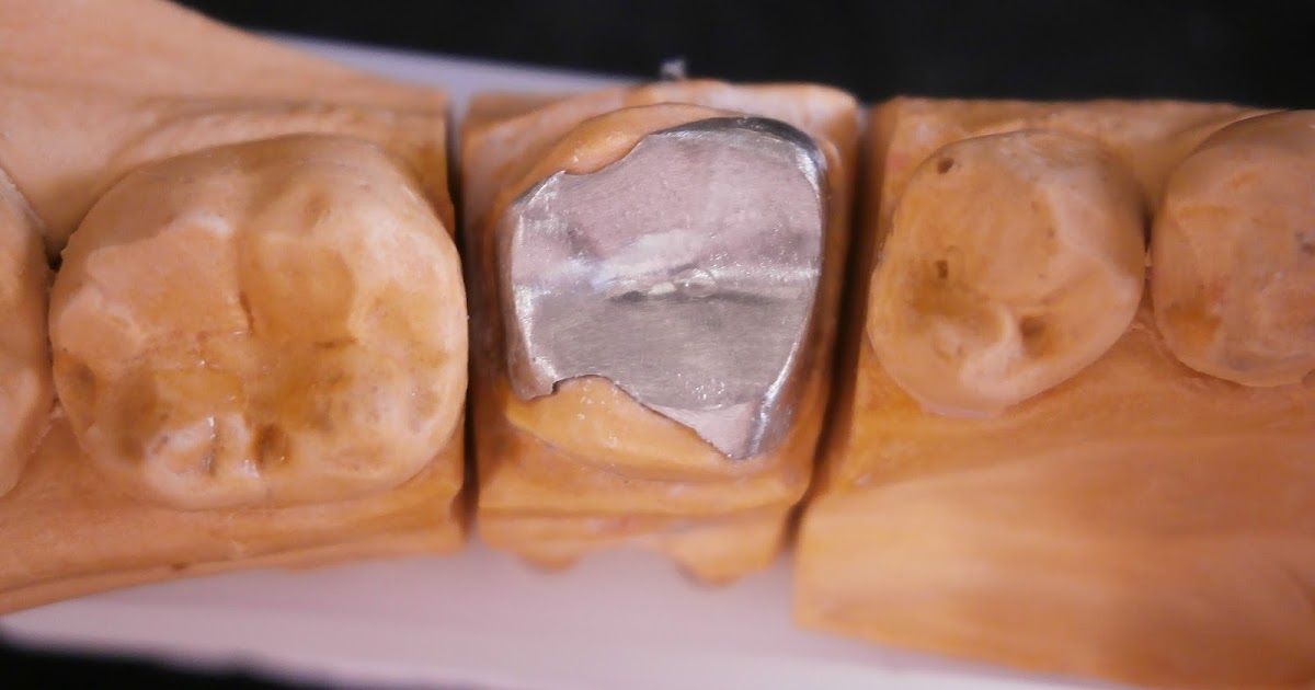 髙田朝（Hajime Takada）のオーダーメイド歯科技工物の紹介 Introduction of custommade dental