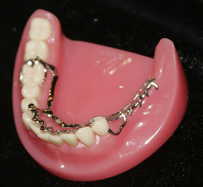 Tác dụng của hàm duy trì sau niềng răng