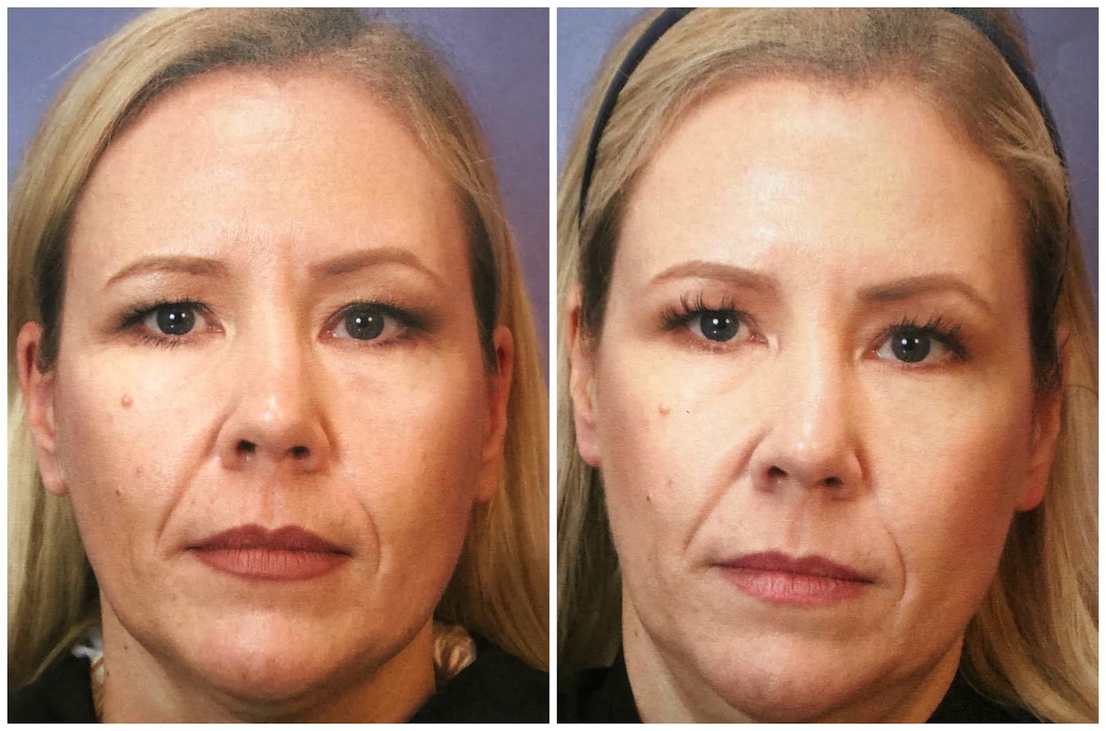 Xeomin Injections Before And After