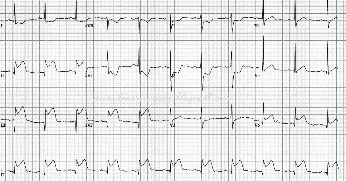 ECG Rhythms Inferior wall STEMI with lesion in the left circumflex