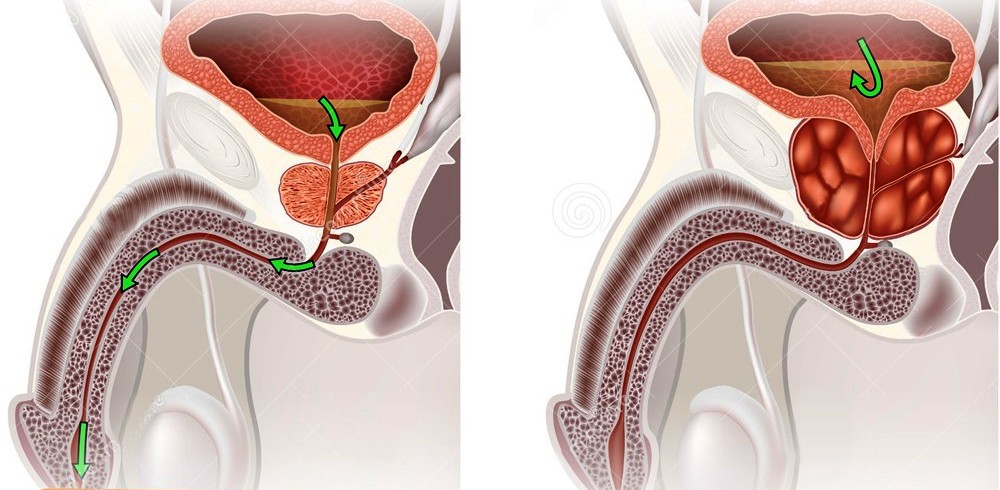 prostatit gomba