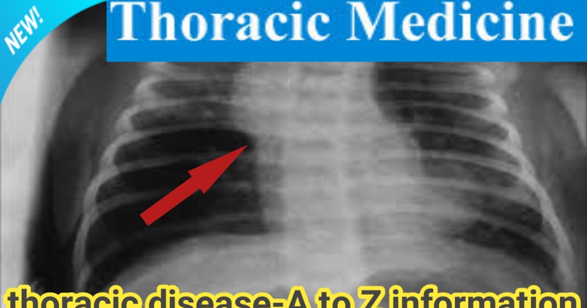 thoracic medicineWhat is thoracic disease? Health Physician