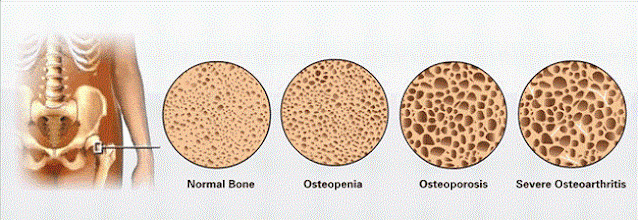 Osteoporosis, osteo, porosis, tulang keropos, tulang rapuh, Jenis-jenis Osteoporosis, Faktor Risiko Osteoporosis, Ciri-ciri Osteoporosis, Diagnosa Osteoporosis, Bahaya Osteoporosis, Pengobatan Osteoporosis, Cara Mencegah Osteoporosis, kepadatan tulang, osteoporosis pada wanita, osteoporosis pada pria, osteoporosis pada anak-anak, osteoporosis pada remaja, osteoporosis pada orang tua, penyebab osteoporosis, definisi osteoporosis, gejala osteoporosis, osteoporosis adalah pengeroposan tulang yang disebabkan oleh, osteoporosis pdf, pencegahan osteoporosis