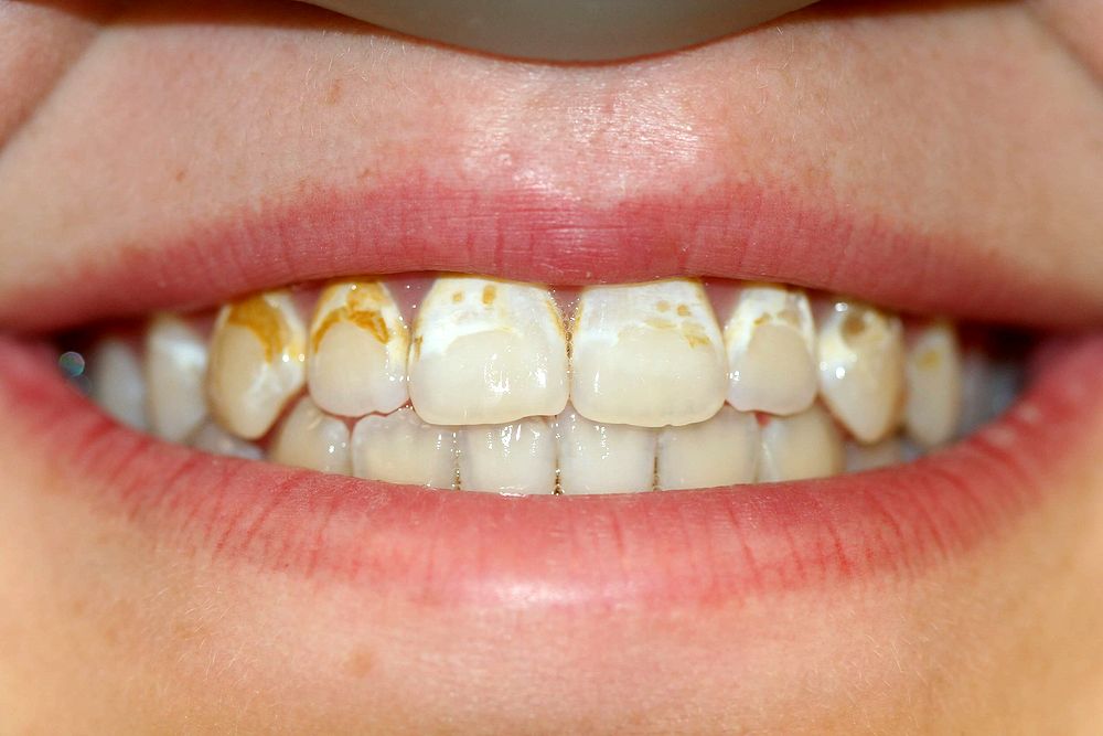 Can I Get A Cavity With Braces? Directorio Odontológico