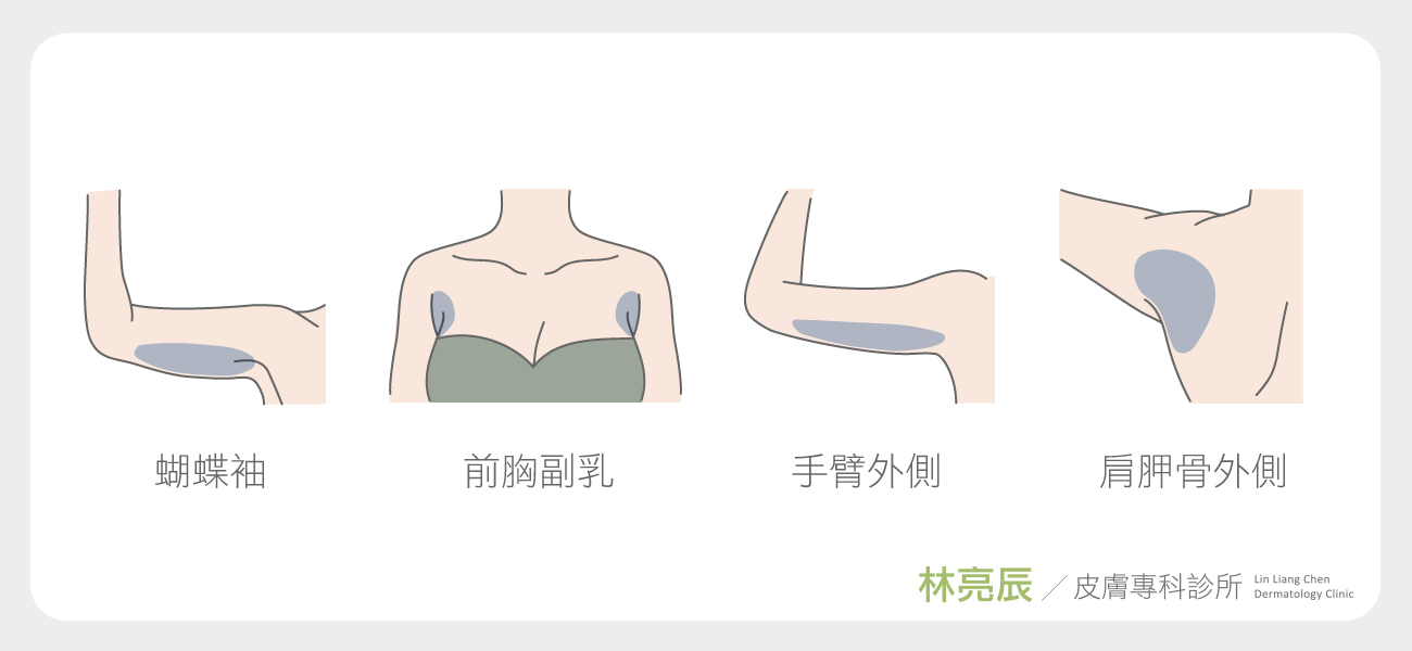 SculpSure絲酷秀雷射體雕體雕非侵入式體雕體外雷射溶脂酷熱減脂費用做幾次術後修復價格恢復期部位大腿肚子抽脂費用新竹非侵入式體雕新竹推薦診所林亮辰皮膚專科診所林亮辰醫師