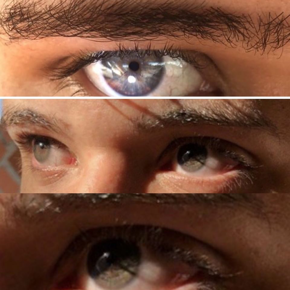 Laser Surgery Helps to Change Eye Color Permanently