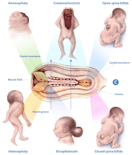 abnormalities due to faulty development, present at birth