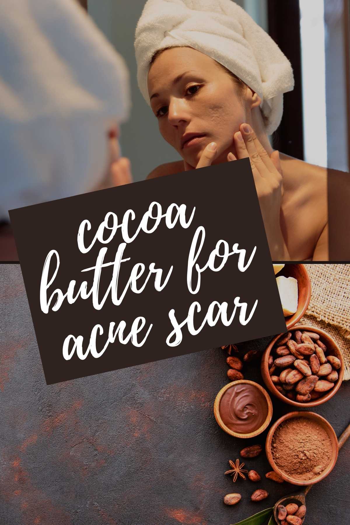 Cocoa butter for acne scars