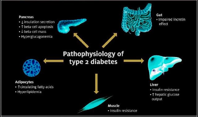 Pathophysiology of type 2 diabetes