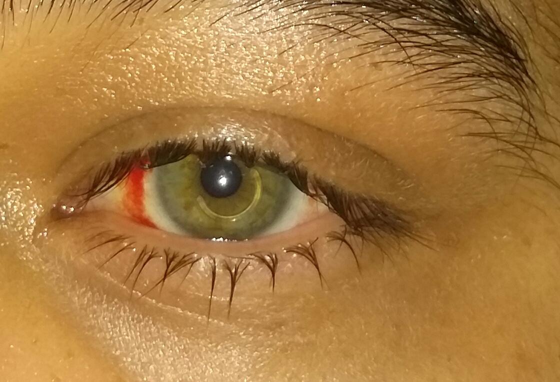 кератоконус форум. кератоглобус и кератоконус. кератоконус форум. кератоглобус и кератоконус. болезнь глаз кератоконус.