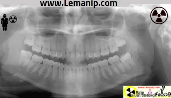 Radiographie Panoramique Maxilaire Anatomie Radiologique Normale