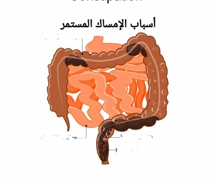 أسباب الإمساك المستمر وعلاجه