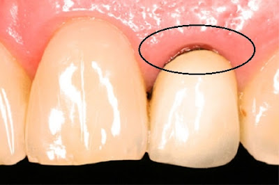 Nhược điểm của bọc răng sứ titan bạn nên biết