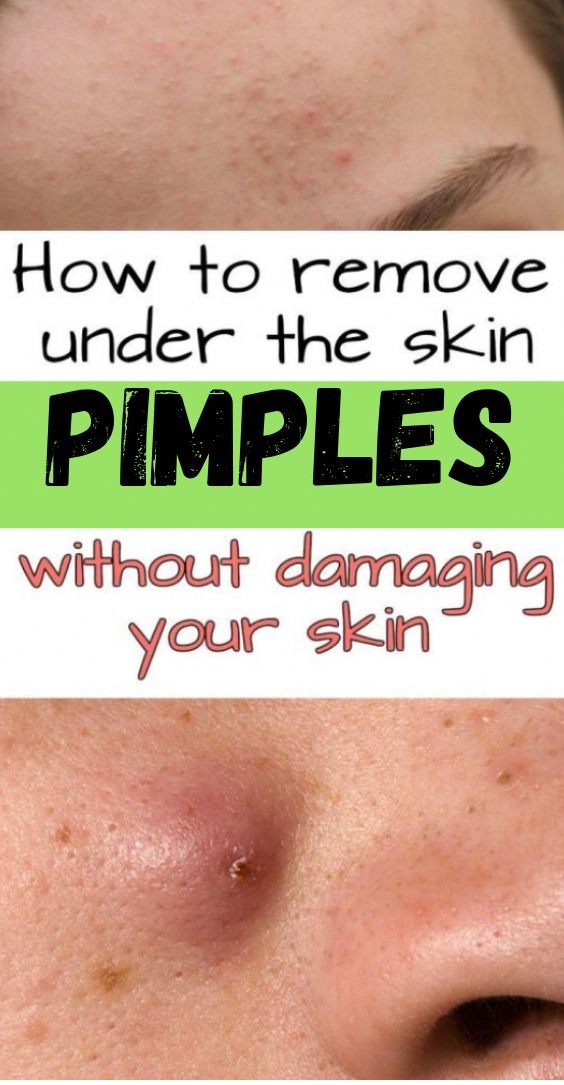 How To Remove Under The Skin Pimples Without Damaging Your Skin