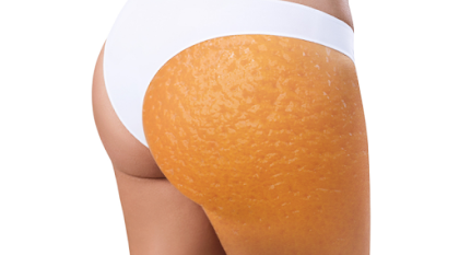 Cellulite