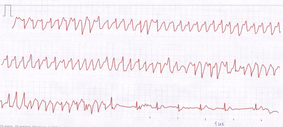 Apple watch ecg looks weird new arrivals