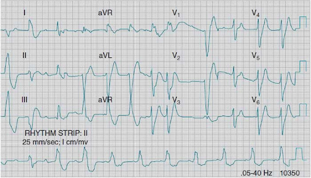 Hyperkalemia due to renal failure