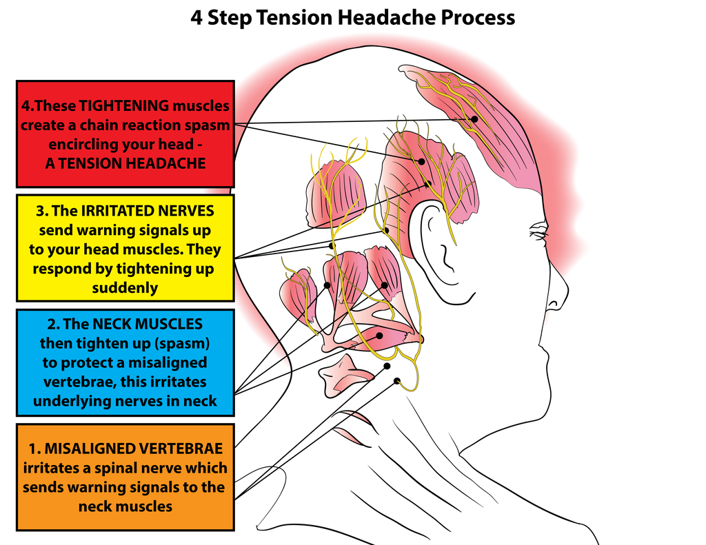 sakit kepala tipe ketegangan analgesik 5