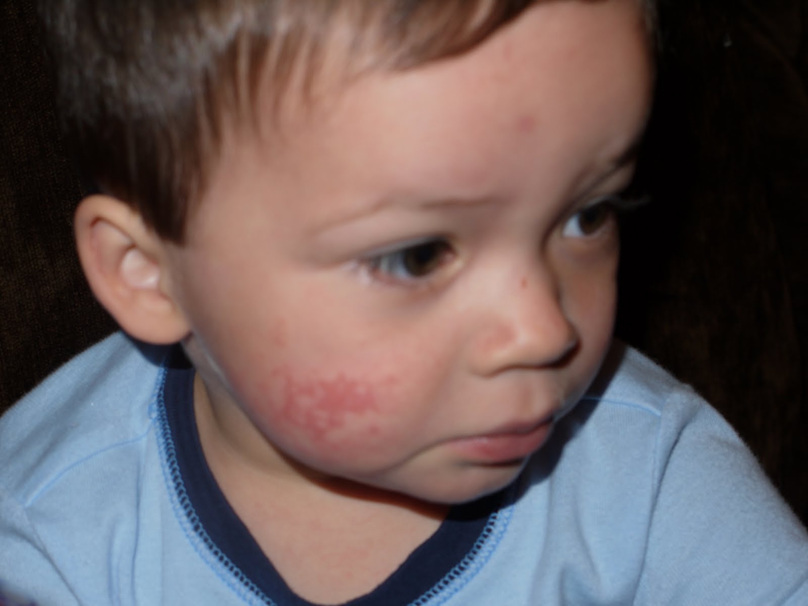 The Mer Show The Latest Ailment Fifth's Disease