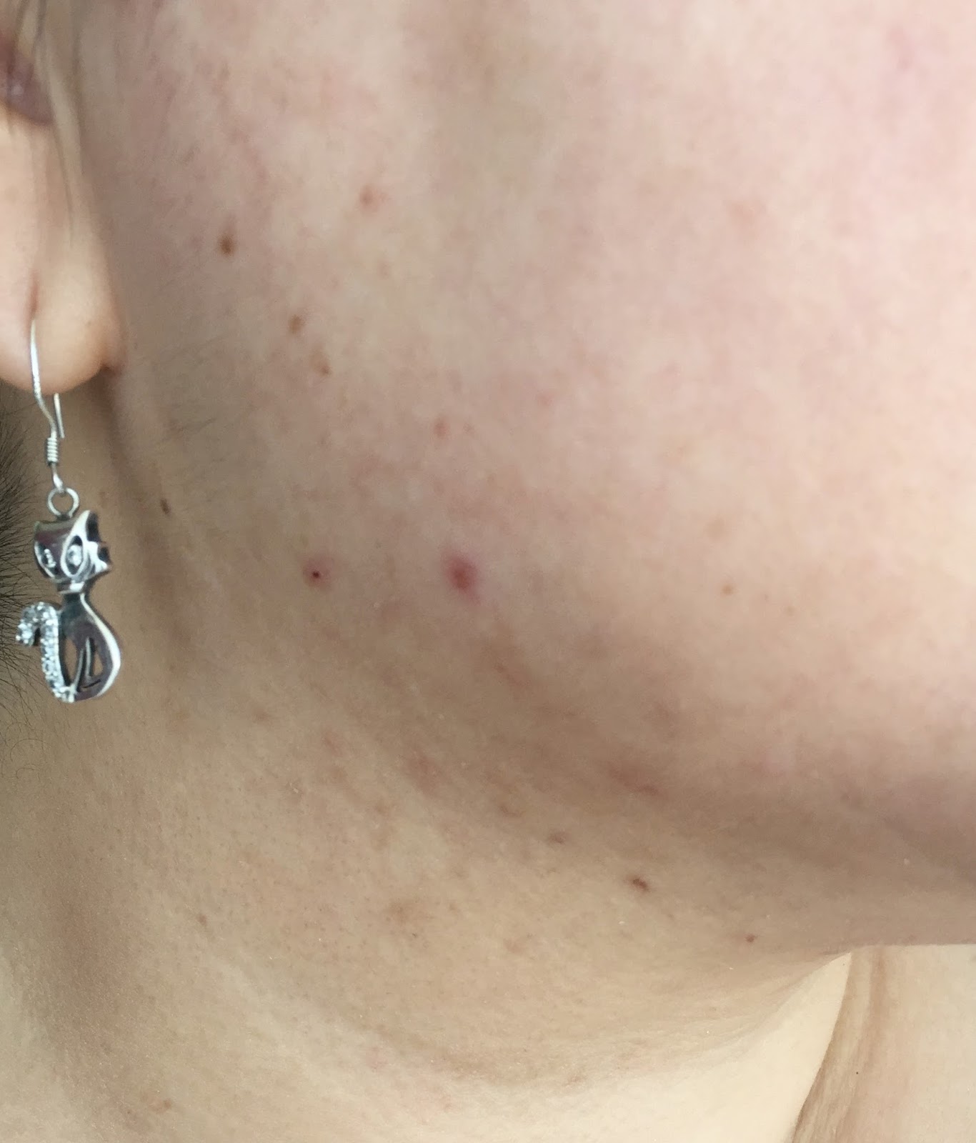Transform Your Skin: The Big Blackhead Transformation Story - zbr6ina