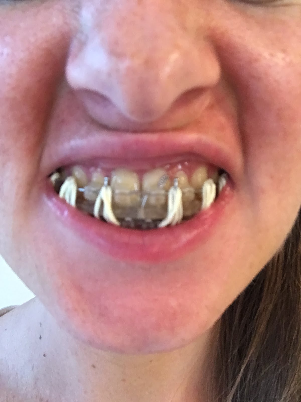 Alison's Jaw Surgery Blog: One Week - First Post-Op